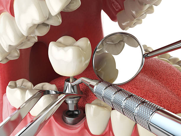 Best Emergency Broken Tooth Repair in Beloit, KS